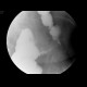 Inflammatory stenosis of sigmoid colon, diverticulitis: RF - Fluoroscopy
