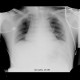 Guide wire in superior vena cava, forgotten: X-ray - Plain radiograph