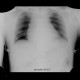 Guide wire in superior vena cava, forgotten: X-ray - Plain radiograph
