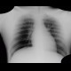 Gunshot wound, thorax, chest wall: X-ray - Plain radiograph