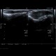 Thickening of nail bed, ultrasound of nail: US - Ultrasound