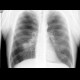 Lobectomy, expaned lung, errect radiograph: X-ray - Plain radiograph