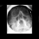 Chronic sinusitis: X-ray - Plain radiograph