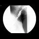 Zenker's diverticulum of the oesophagus: RF - Fluoroscopy