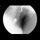 Zenker's diverticulum of the oesophagus: RF - Fluoroscopy