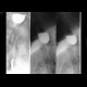 Large Zenker's diverticulum: RF - Fluoroscopy
