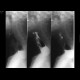 Large Zenker's diverticulum: RF - Fluoroscopy
