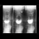 Large Zenker's diverticulum: RF - Fluoroscopy