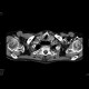 Large Zenker's diverticulum: CT - Computed tomography