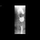 Large Zenker's diverticulum: RF - Fluoroscopy