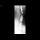 Large Zenker's diverticulum: RF - Fluoroscopy