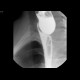 Large Zenker's diverticulum: RF - Fluoroscopy