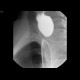 Large Zenker's diverticulum: RF - Fluoroscopy