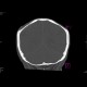 Foramina parietalia, skull fissure: CT - Computed tomography