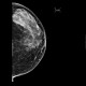 Glandular type, normal mammography, : X-ray - Plain radiograph