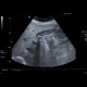 Gallstones, cholecystolithiasis, sludge, twinkling artifact: US - Ultrasound