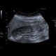 Gallstones, cholecystolithiasis, sludge, twinkling artifact: US - Ultrasound