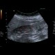 Gallstones, cholecystolithiasis, sludge, twinkling artifact: US - Ultrasound