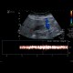 Gallstones, cholecystolithiasis, sludge, twinkling artifact: US - Ultrasound