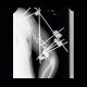 Gunshot wound of humerus, osteosynthesis: X-ray - Plain radiograph