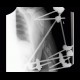 Gunshot wound of humerus, osteosynthesis: X-ray - Plain radiograph