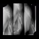 Gunshot wound of humerus, osteosynthesis: X-ray - Plain radiograph