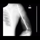 Gunshot wound of humerus, osteosynthesis: X-ray - Plain radiograph