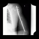 Gunshot wound of humerus, osteosynthesis: X-ray - Plain radiograph