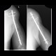 Gunshot wound of humerus, osteosynthesis: X-ray - Plain radiograph