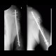 Gunshot wound of humerus, osteosynthesis: X-ray - Plain radiograph