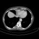Adrenal metastasis and skeletal metastasis of pulmonary carcinoma, correlation, initial examination: CT - Computed tomography