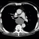 Fibrovascular polyp of oesophagus: CT - Computed tomography