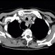 Fibrovascular polyp of oesophagus: CT - Computed tomography