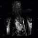 Fibrovascular polyp of oesophagus: MRI - Magnetic Resonance Imaging