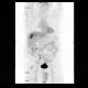 Liver metastasis of adenocarcinoma of colon, colorectal carcinoma, biopsy, PET: NM - Nuclear medicine