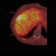 Liver metastasis of adenocarcinoma of colon, colorectal carcinoma, biopsy, PET: NM - Nuclear medicine