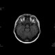 Adenoma of the hypophysis: MRI - Magnetic Resonance Imaging