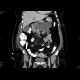 Acute necrosing pancreatitis: CT - Computed tomography