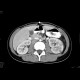 Acute pyelonephritis, left kidney: CT - Computed tomography