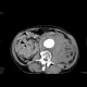 Aneurysm of abdominal aorta, AAA, ruptured, retroperitoneal bleeding: CT - Computed tomography