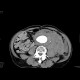 Aneurysm of abdominal aorta, AAA, ruptured, retroperitoneal bleeding: CT - Computed tomography