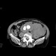 Aneurysm of abdominal aorta, AAA, ruptured, retroperitoneal bleeding: CT - Computed tomography