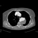 Dissecting aneurysm of the thoracic aorta, thrombosis of false lumen: CT - Computed tomography