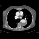 Dissecting aneurysm of the thoracic aorta, thrombosis of false lumen: CT - Computed tomography