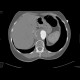 Dissecting aneurysm of the thoracic aorta, thrombosis of false lumen: CT - Computed tomography