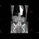 Dissecting aneurysm of the thoracic aorta, thrombosis of false lumen: CT - Computed tomography