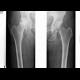 Aseptic necrosis of the femoral head: X-ray - Plain radiograph