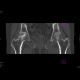 Aseptic necrosis of the femoral head: CT - Computed tomography