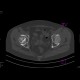 Aseptic necrosis of the femoral head: CT - Computed tomography