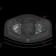 Aseptic necrosis of the femoral head: CT - Computed tomography